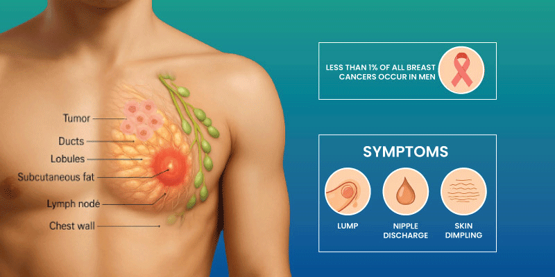 stages of male breast cancer progression diagram