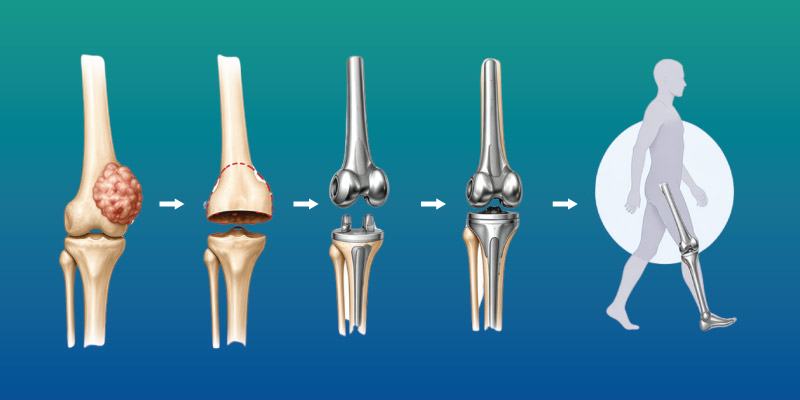 osteosarcoma surgery showing limb salvage and reconstruction approach
