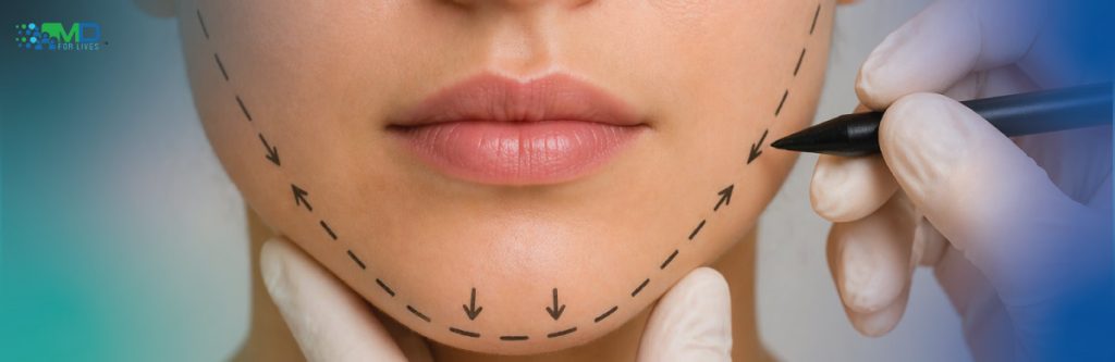 perioral mound liposuction
