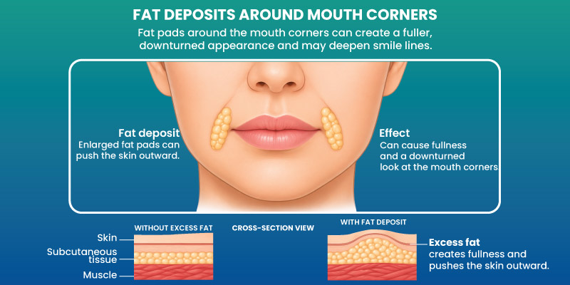 perioral mound liposuction procedure using micro cannula