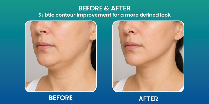 perioral mound liposuction before and after showing improved facial contour